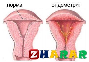 Эндометрит